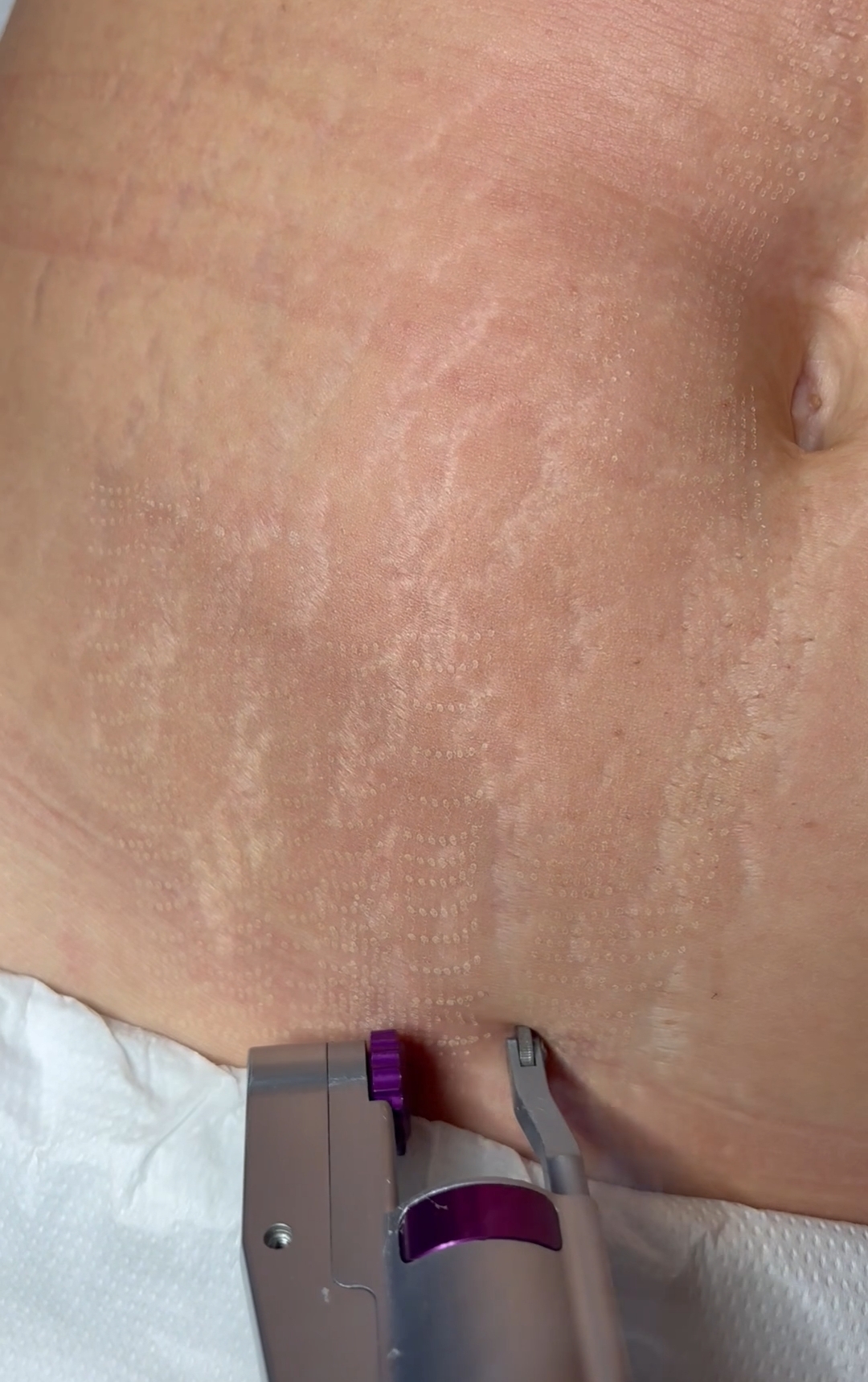 czy można pozbyć się rozstępów