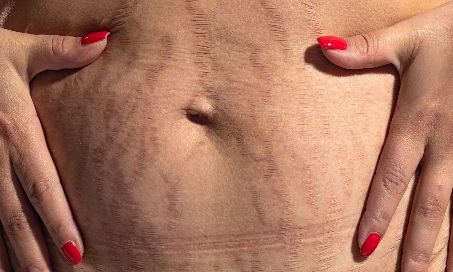 Jak pozbyć się rozstępów