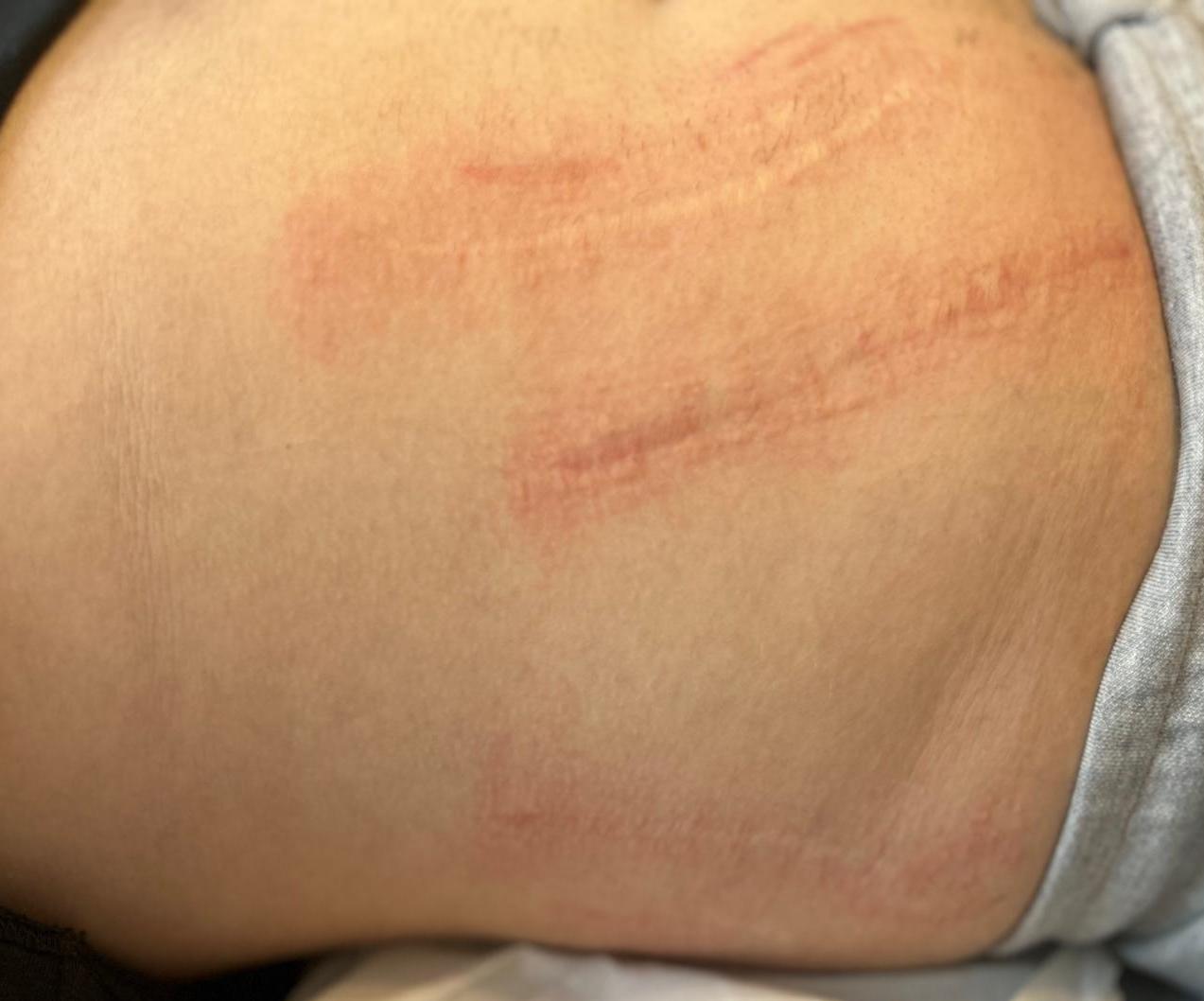 jak pozbyć się rozstępów po ciąży